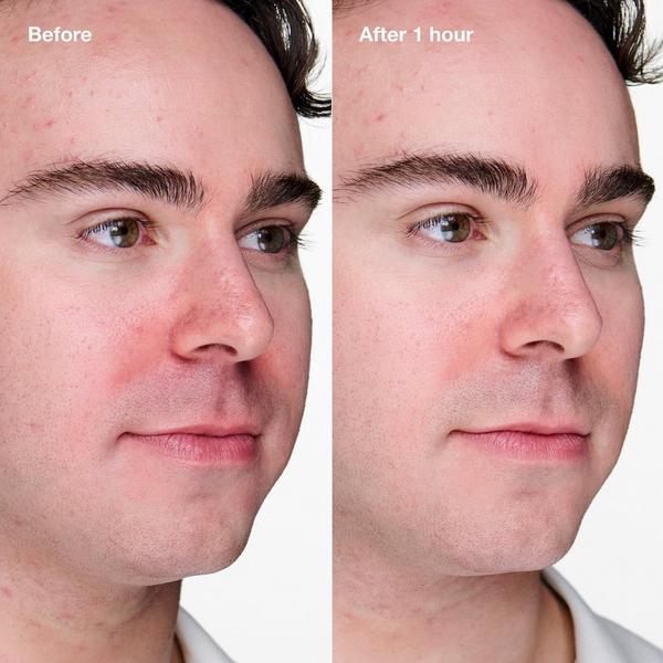 Ulta Clinique  Acne Solutions Clinical Advanced Clearing Gel With Salicylic Acid