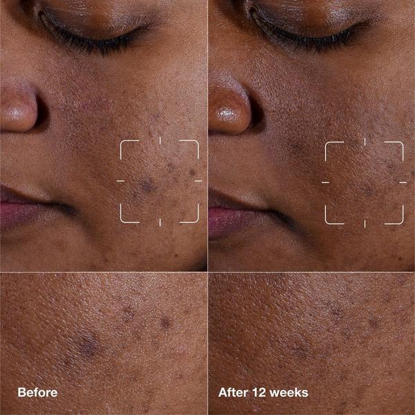 Ulta Clinique  Even Better Clinical Dark Spot Clearing Serum With Vitamin C