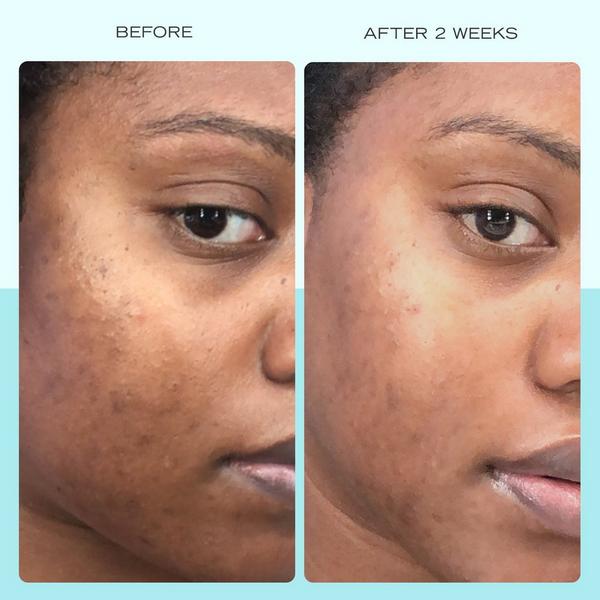 Ulta First Aid Beauty  Facial Radiance Niacinamide Dark Spot Serum