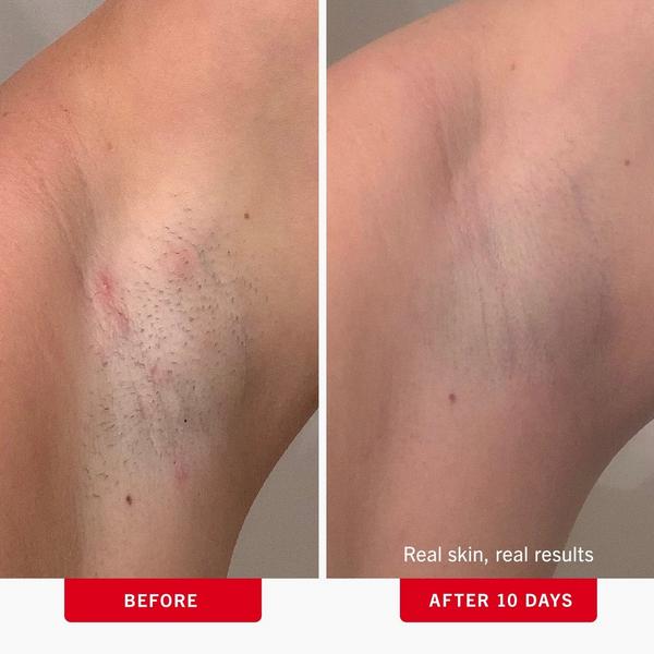 Ulta First Aid Beauty  Ingrown Hair Pads With BHA & AHA