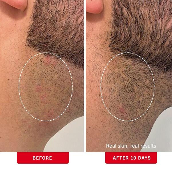 Ulta First Aid Beauty  Ingrown Hair Pads With BHA & AHA