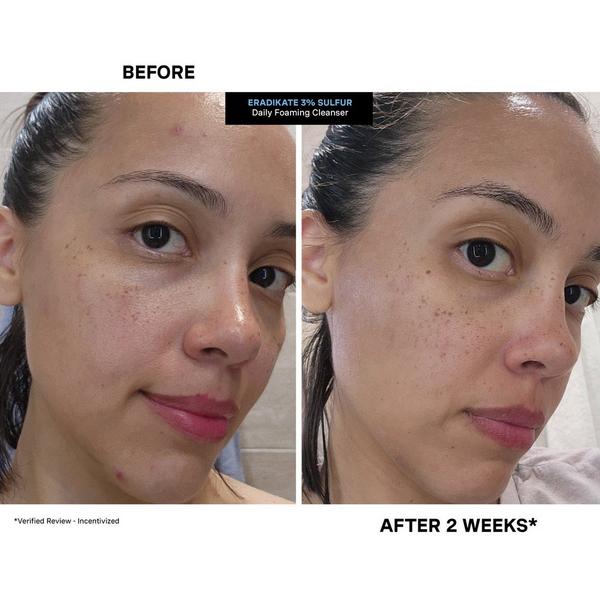 Ulta Kate Somerville  EradiKate 3% Sulfur Daily Foaming Cleanser