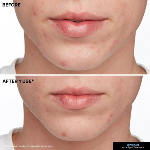 Ulta Kate Somerville  EradiKate Acne Spot Treatment With 10% Sulfur