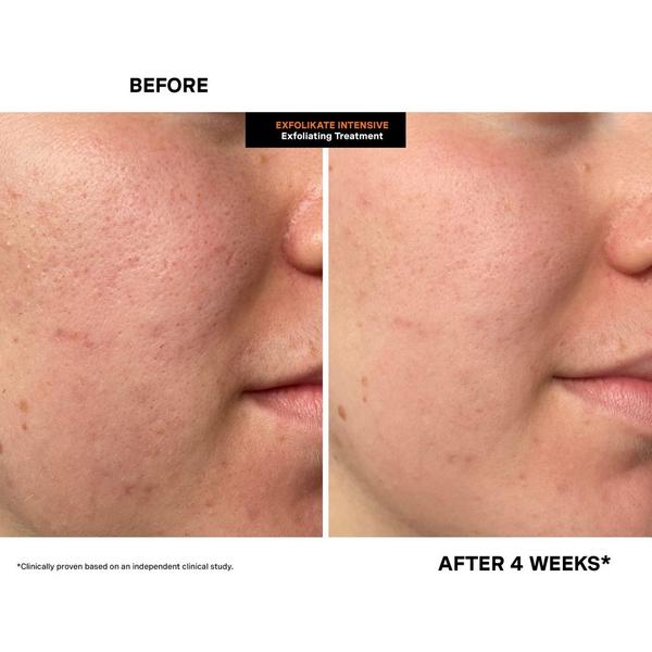 Ulta Kate Somerville  ExfoliKate Intensive Exfoliating Treatment