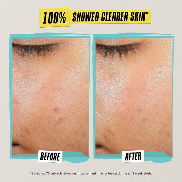 Ulta Kiehl's Since 1851  Expertly Clear Acne - Treating & Preventing Lotion