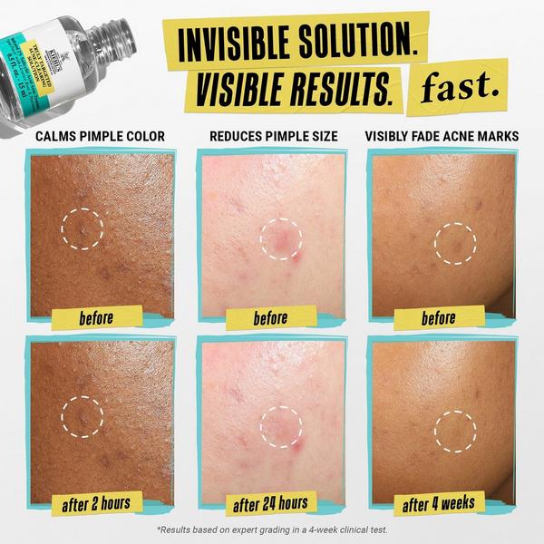 Ulta Kiehl's Since 1851  Truly Targeted Acne-Clearing Solution With Salicylic Acid