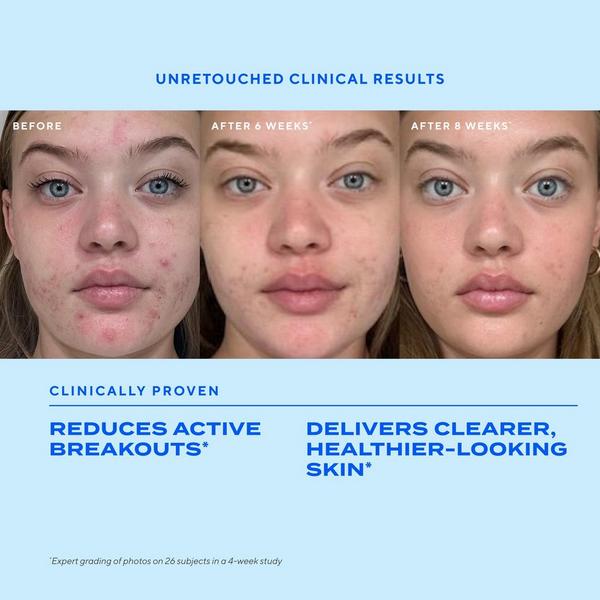 Ulta Murad  Biome-Balancing Clear & Prevent Acne Treatment Serum