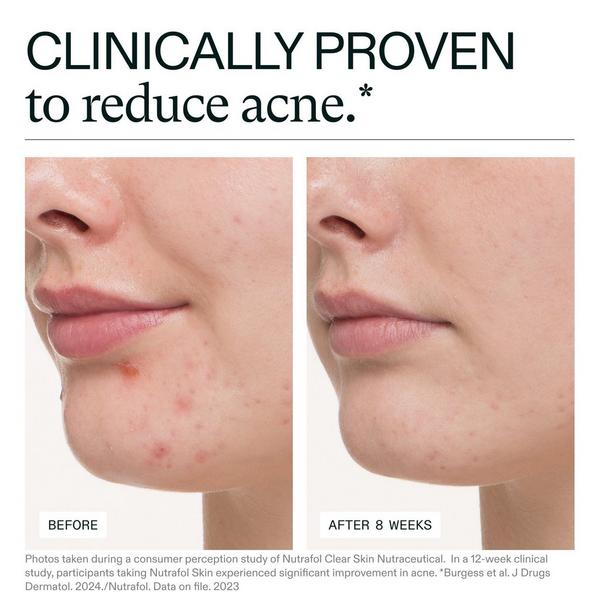 Ulta NUTRAFOL  Clear Skin Clinically Proven Supplement For Acne + Breakouts