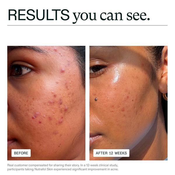 Ulta NUTRAFOL  Clear Skin Clinically Proven Supplement For Acne + Breakouts