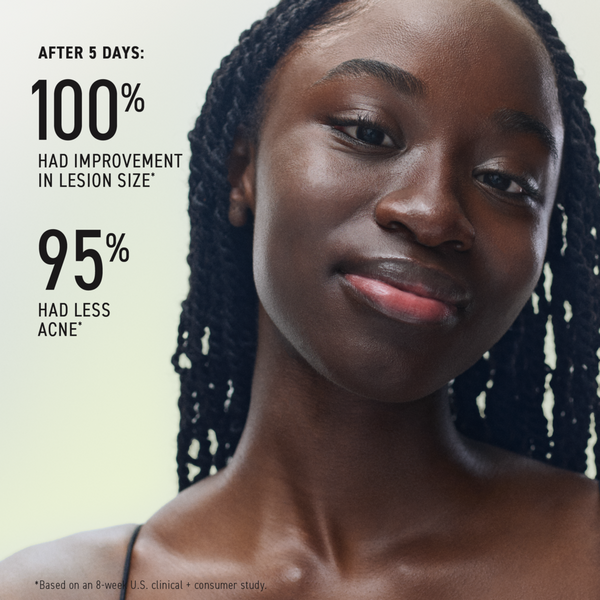 Ulta RODAN + FIELDS  Spotless 30-Day Regimen For Teen Acne