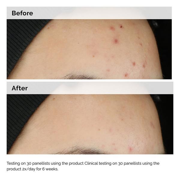 Ulta The Ordinary  Balancing & Clarifying Serum For Oily Skin And Pore Refinement