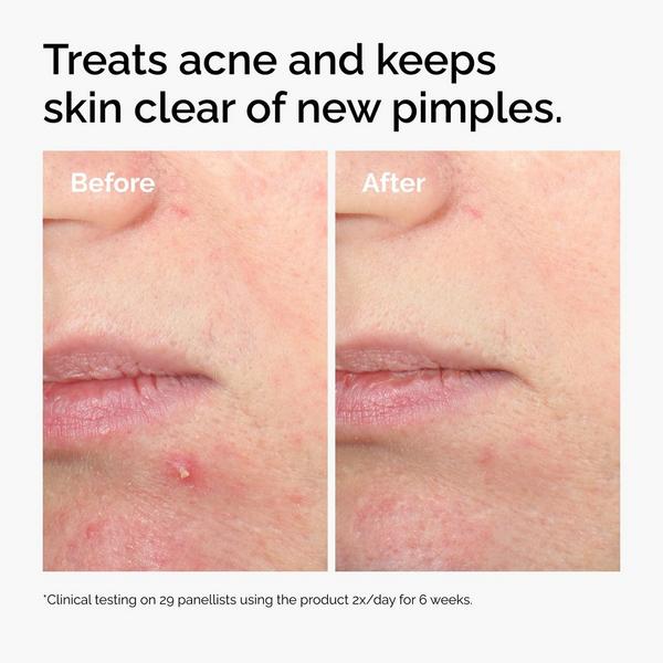 Ulta The Ordinary Salicylic Acid 2% Solution Exfoliating Serum For Acne