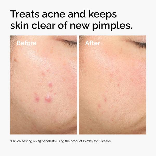 Ulta The Ordinary Salicylic Acid 2% Solution Exfoliating Serum For Acne
