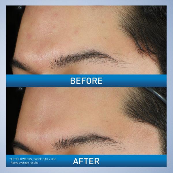 Ulta CeraVe  Acne Foaming Cream Wash