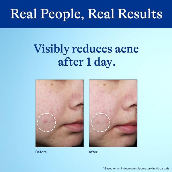 Ulta Differin  10% Benzoyl Peroxide Spot Treatment