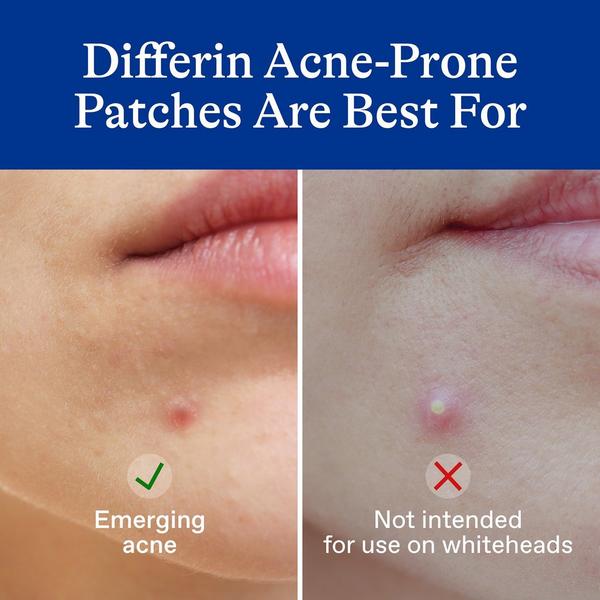 Ulta Differin  Acne Prone Skin Patches