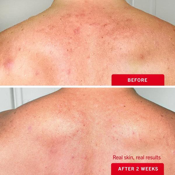 Ulta First Aid Beauty  Body Acne Clearing Mist