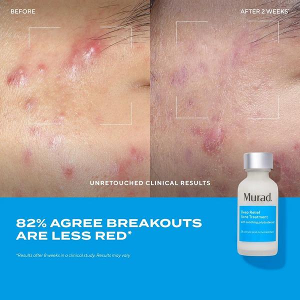 Ulta Murad  Deep Relief Acne Treatment