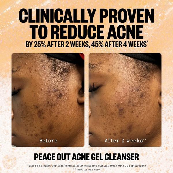 Ulta Peace Out  2% Salicylic Acid Acne Gel Cleanser