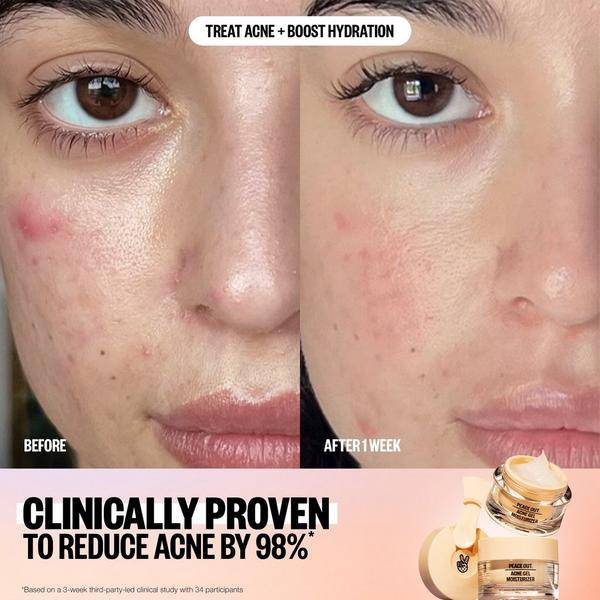 Ulta Peace Out  Acne Gel Moisturizer