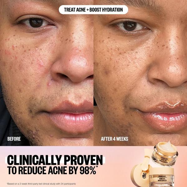 Ulta Peace Out  Acne Gel Moisturizer