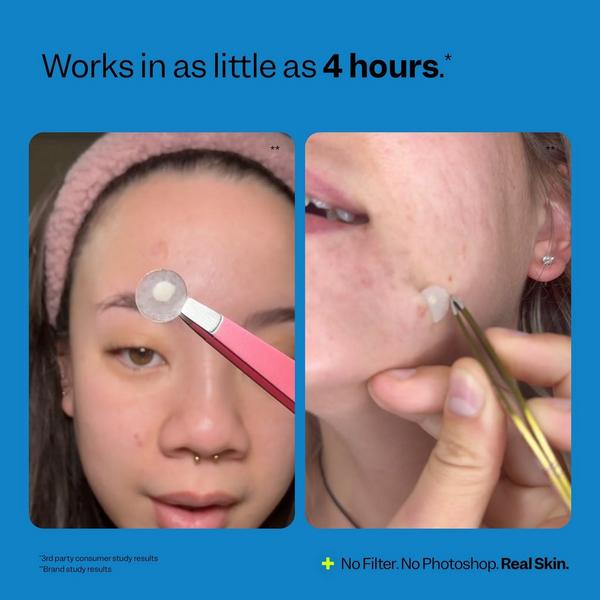 Ulta Peach Slices  Acne Spot Dots