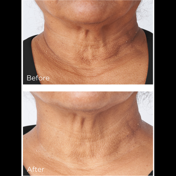 Ulta Perricone MD  Cold Plasma Plus+ Sub-D/Neck