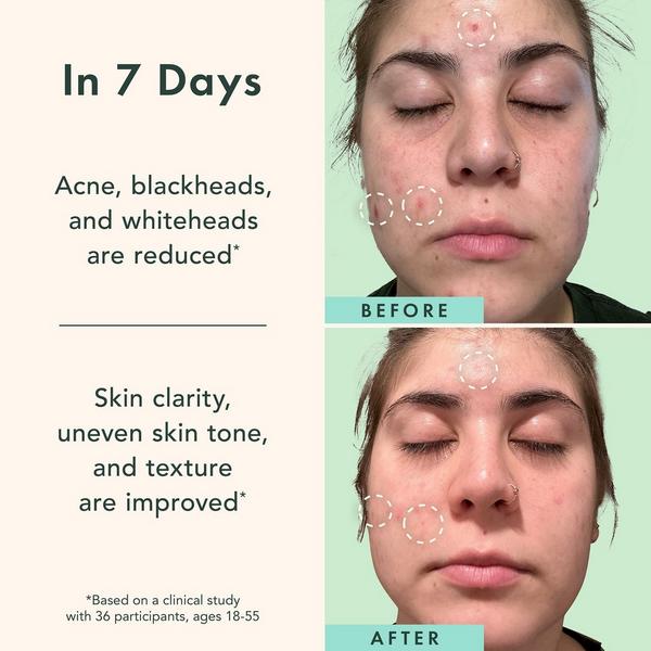 Ulta Rael  Miracle Clear Complete Acne Serum